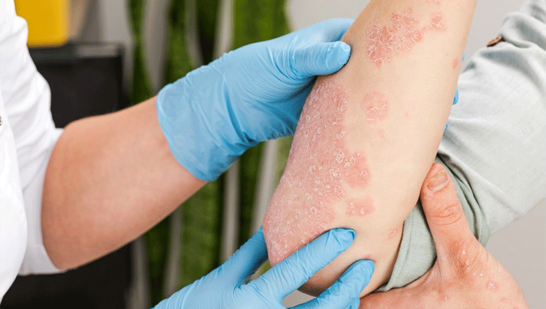 psoriasis